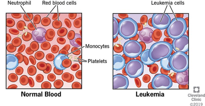 Leukemia acute quiz pathology aml