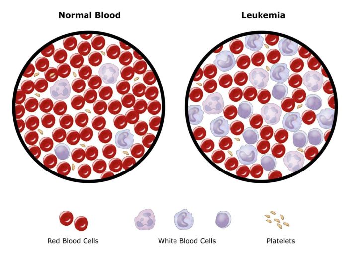 Do i have leukemia quiz